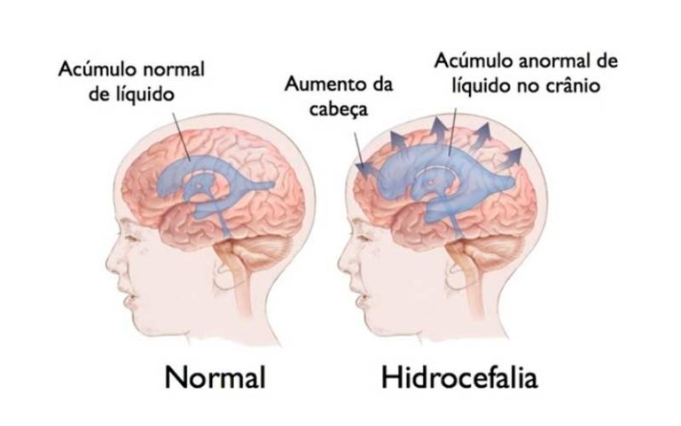 Hidrocefalia Neurocirurgião Com Tratamento Para Hidrocefalia 7933