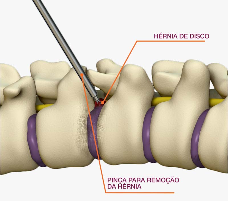 Cirurgia de Hérnia de Disco - Coluna SP