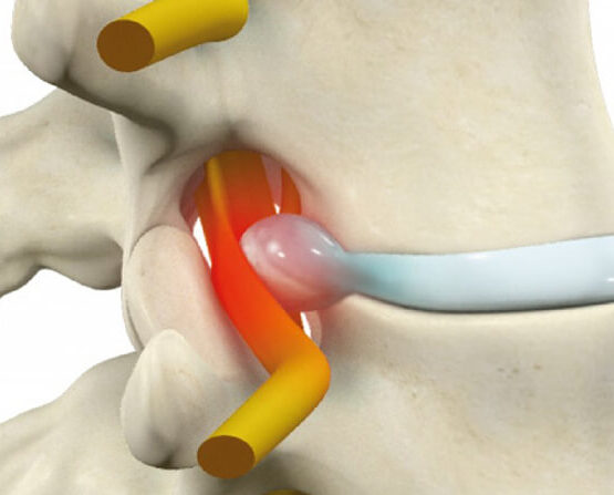 Ilustração anatômica detalhada de um disco herniado na coluna vertebral. A imagem mostra as vértebras da coluna, o disco intervertebral e os nervos. O disco intervertebral aparece deslocado, pressionando um nervo adjacente, representado em amarelo. A área de compressão é destacada com um brilho vermelho, indicando inflamação ou dor. Essa representação visual explica a condição da hérnia de disco, que pode causar dores intensas nas costas e sintomas neurológicos.