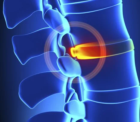 Ilustração médica da coluna vertebral humana, destacando um disco intervertebral em vermelho-alaranjado, sugerindo inflamação ou lesão. O restante da coluna é representado em tons de azul brilhante, criando um contraste visual que enfatiza a área problemática. Essa imagem é utilizada para ilustrar condições como hérnia de disco ou degeneração discal, ajudando na explicação médica da dor e suas possíveis causas.